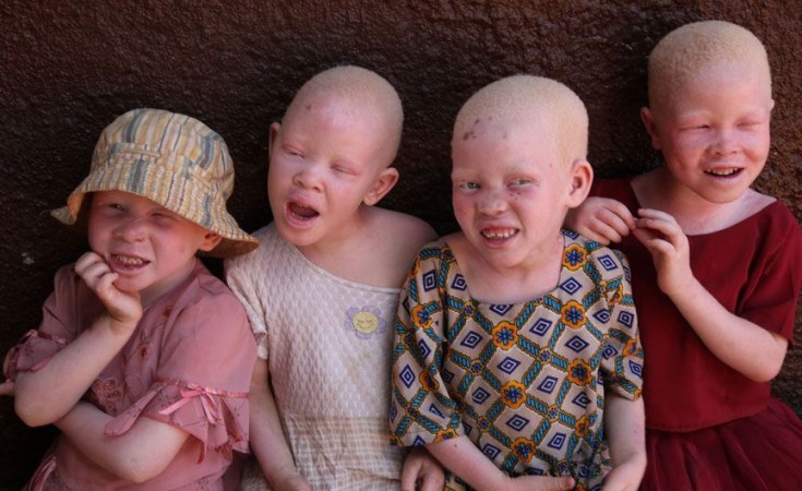 RDC/13 Juin 2022, le monde entier célèbre la journée de sensibilisation à l’albinisme